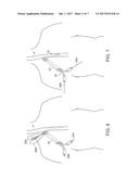 Methods and Apparatus for Inserting Multi-Lumen Split-Tip Catheters Into a     Blood Vessel diagram and image