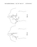 Methods and Apparatus for Inserting Multi-Lumen Split-Tip Catheters Into a     Blood Vessel diagram and image
