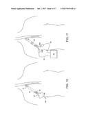 Methods and Apparatus for Inserting Multi-Lumen Split-Tip Catheters Into a     Blood Vessel diagram and image