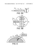 Neurotrophic Electrode System diagram and image