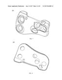 PROXIMAL BUNION RESECTION GUIDES AND PLATES AND METHODS OF USE diagram and image