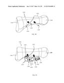 PROXIMAL BUNION RESECTION GUIDES AND PLATES AND METHODS OF USE diagram and image