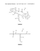 BONE FIXATION DEVICES AND METHODS diagram and image