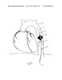 SYSTEMS, DEVICES AND METHODS FOR RESUSCITATION diagram and image