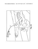 SURGICAL ARTICLES AND METHODS diagram and image