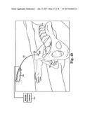 SURGICAL ARTICLES AND METHODS diagram and image