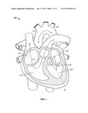 MITRAL VALVE REPLACEMENT TOGGLE CELL SECUREMENT diagram and image