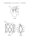 MITRAL VALVE REPLACEMENT TOGGLE CELL SECUREMENT diagram and image