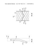 MITRAL VALVE REPLACEMENT TOGGLE CELL SECUREMENT diagram and image