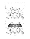 MITRAL VALVE REPLACEMENT TOGGLE CELL SECUREMENT diagram and image