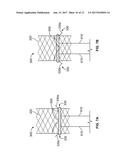 MITRAL VALVE REPLACEMENT TOGGLE CELL SECUREMENT diagram and image