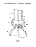 DELIVERY SYSTEM HAVING RETRACTABLE WIRES AS A COUPLING MECHANISM AND A     DEPLOYMENT MECHANISM FOR A SELF-EXPANDING PROSTHESIS diagram and image
