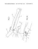 INTERNAL JOINT STABILIZER DEVICE, SYSTEM AND METHOD OF USE diagram and image