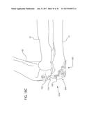 INTERNAL JOINT STABILIZER DEVICE, SYSTEM AND METHOD OF USE diagram and image