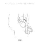 OCCLUSION IMPLANT diagram and image