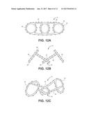 OCCLUSION IMPLANT diagram and image