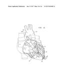 VENTRICULAR ASSIST DEVICE FOR INTRAVENTRICULAR PLACEMENT diagram and image