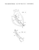 VENTRICULAR ASSIST DEVICE FOR INTRAVENTRICULAR PLACEMENT diagram and image