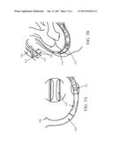 DEVICES AND METHODS FOR CONTROLLING BLOOD PERFUSION PRESSURE diagram and image