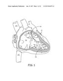 TINE FIXATION COMPONENTS FOR IMPLANTABLE MEDICAL DEVICES diagram and image