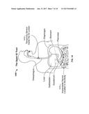 Device and Implantation System for Electrical Stimulation of Biological     Systems diagram and image