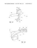 ENDOLUMINAL SIZING DEVICE diagram and image