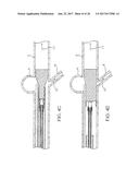 ANEURSYM OCCLUSION SYSTEM AND METHOD diagram and image