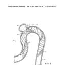 ANEURSYM OCCLUSION SYSTEM AND METHOD diagram and image