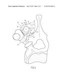 VERTEBRAL FIXING SYSTEM diagram and image