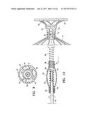 SYSTEM FOR IMPROVING CARDIAC FUNCTION BY SEALING A PARTITIONING MEMBRANE     WITHIN A VENTRICLE diagram and image