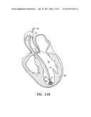 SYSTEM FOR IMPROVING CARDIAC FUNCTION BY SEALING A PARTITIONING MEMBRANE     WITHIN A VENTRICLE diagram and image