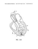 SYSTEM FOR IMPROVING CARDIAC FUNCTION BY SEALING A PARTITIONING MEMBRANE     WITHIN A VENTRICLE diagram and image