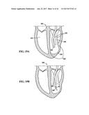 SYSTEM FOR IMPROVING CARDIAC FUNCTION BY SEALING A PARTITIONING MEMBRANE     WITHIN A VENTRICLE diagram and image