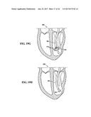 SYSTEM FOR IMPROVING CARDIAC FUNCTION BY SEALING A PARTITIONING MEMBRANE     WITHIN A VENTRICLE diagram and image