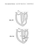 SYSTEM FOR IMPROVING CARDIAC FUNCTION BY SEALING A PARTITIONING MEMBRANE     WITHIN A VENTRICLE diagram and image