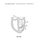 SYSTEM FOR IMPROVING CARDIAC FUNCTION BY SEALING A PARTITIONING MEMBRANE     WITHIN A VENTRICLE diagram and image