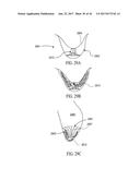 SYSTEM FOR IMPROVING CARDIAC FUNCTION BY SEALING A PARTITIONING MEMBRANE     WITHIN A VENTRICLE diagram and image