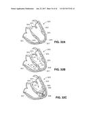 SYSTEM FOR IMPROVING CARDIAC FUNCTION BY SEALING A PARTITIONING MEMBRANE     WITHIN A VENTRICLE diagram and image