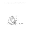 SYSTEM FOR IMPROVING CARDIAC FUNCTION BY SEALING A PARTITIONING MEMBRANE     WITHIN A VENTRICLE diagram and image