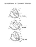 SYSTEM FOR IMPROVING CARDIAC FUNCTION BY SEALING A PARTITIONING MEMBRANE     WITHIN A VENTRICLE diagram and image