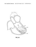 SYSTEM FOR IMPROVING CARDIAC FUNCTION BY SEALING A PARTITIONING MEMBRANE     WITHIN A VENTRICLE diagram and image