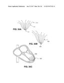 SYSTEM FOR IMPROVING CARDIAC FUNCTION BY SEALING A PARTITIONING MEMBRANE     WITHIN A VENTRICLE diagram and image