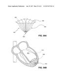 SYSTEM FOR IMPROVING CARDIAC FUNCTION BY SEALING A PARTITIONING MEMBRANE     WITHIN A VENTRICLE diagram and image