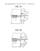 Expandable Ring Intervertebral Fusion Device diagram and image