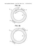 Expandable Ring Intervertebral Fusion Device diagram and image