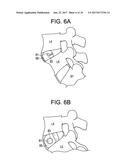 Expandable Ring Intervertebral Fusion Device diagram and image