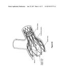 PULMONARY ARTERY IMPLANT APPARATUS AND METHODS OF USE THEREOF diagram and image