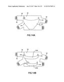 TWO-PART NON-PLANAR GRADUATED COMPRESSION DEVICE FOR THE TREATMENT OF     CIRCULATORY DISORDERS diagram and image