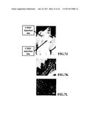 ISOLATION AND USE OF SOLID TUMOR STEM CELLS diagram and image