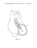 GUIDE FEATURES FOR PERCUTANEOUS CATHETER PUMP diagram and image